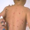 Kasaï-Oriental : la population appelle les autorités à vite réagir pour mettre fin à l’épidémie de rougeole